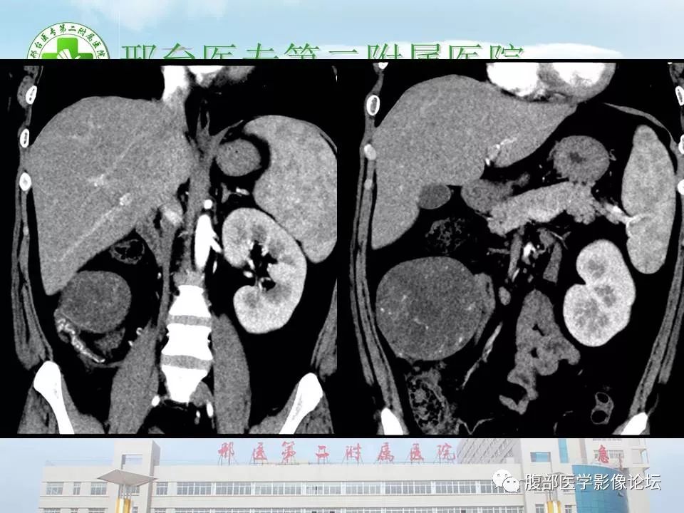 【病例】腹腔卵黄囊瘤1例CT影像表现 【病例】腹腔卵黄囊瘤1例CT影像表现