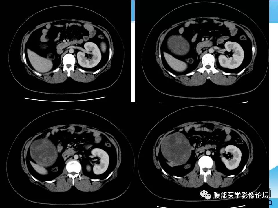 【病例】腹腔卵黄囊瘤1例CT影像表现 【病例】腹腔卵黄囊瘤1例CT影像表现