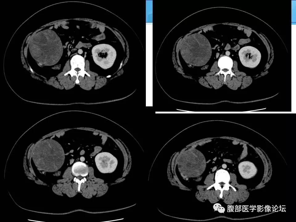 【病例】腹腔卵黄囊瘤1例CT影像表现 【病例】腹腔卵黄囊瘤1例CT影像表现