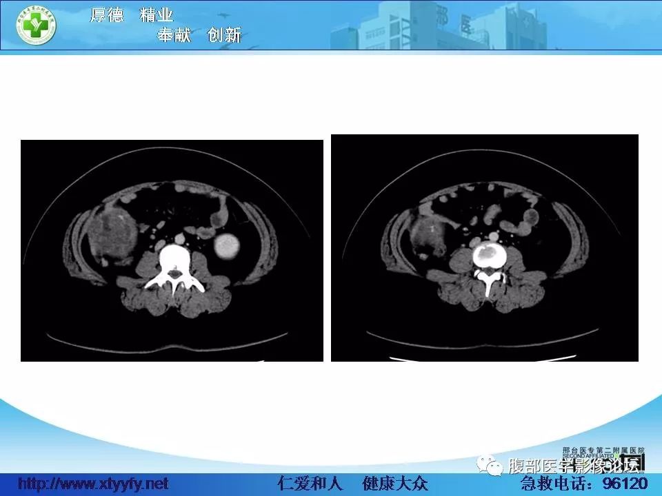 【病例】腹腔卵黄囊瘤1例CT影像表现 【病例】腹腔卵黄囊瘤1例CT影像表现