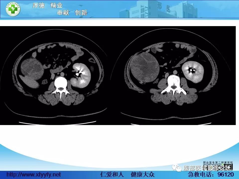 【病例】腹腔卵黄囊瘤1例CT影像表现 【病例】腹腔卵黄囊瘤1例CT影像表现