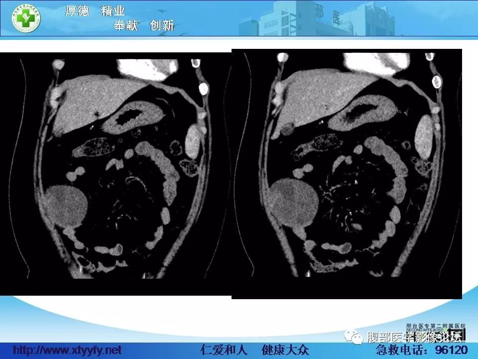 【病例】腹腔卵黄囊瘤1例CT影像表现 【病例】腹腔卵黄囊瘤1例CT影像表现