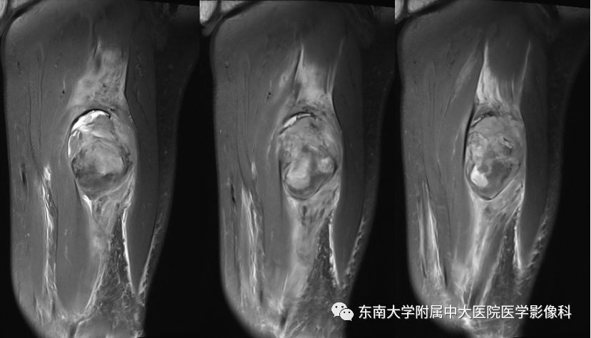 【病例】大腿黏液纤维肉瘤1例MR影像表现