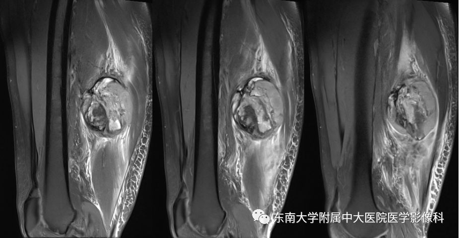 【病例】大腿黏液纤维肉瘤1例MR影像表现