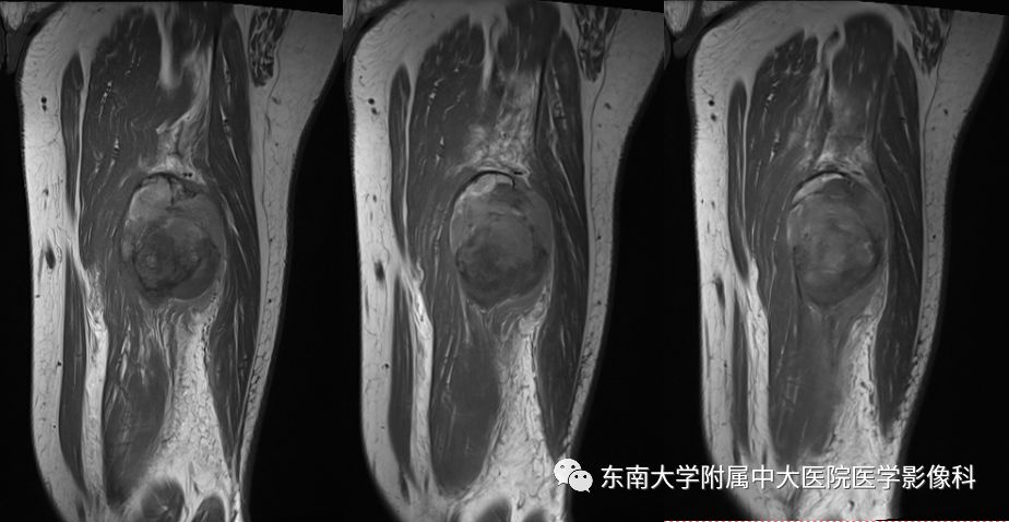 【病例】大腿黏液纤维肉瘤1例MR影像表现