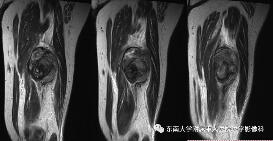 【病例】大腿黏液纤维肉瘤1例MR影像表现