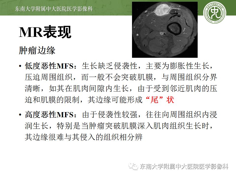 【病例】大腿黏液纤维肉瘤1例MR影像表现