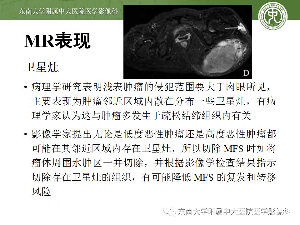 【病例】大腿黏液纤维肉瘤1例MR影像表现