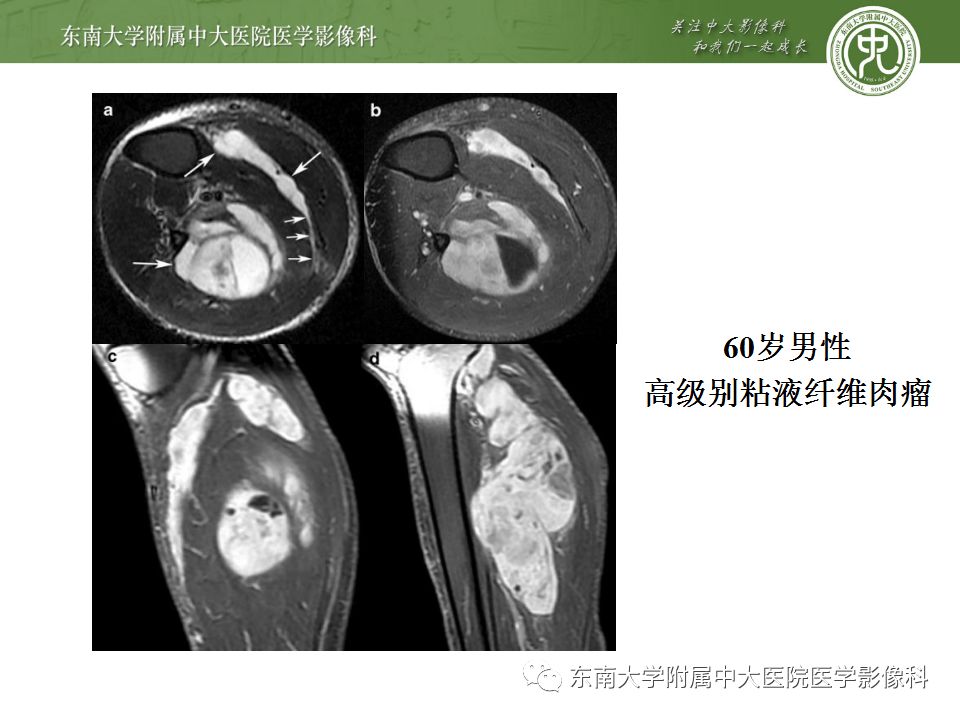 【病例】大腿黏液纤维肉瘤1例MR影像表现