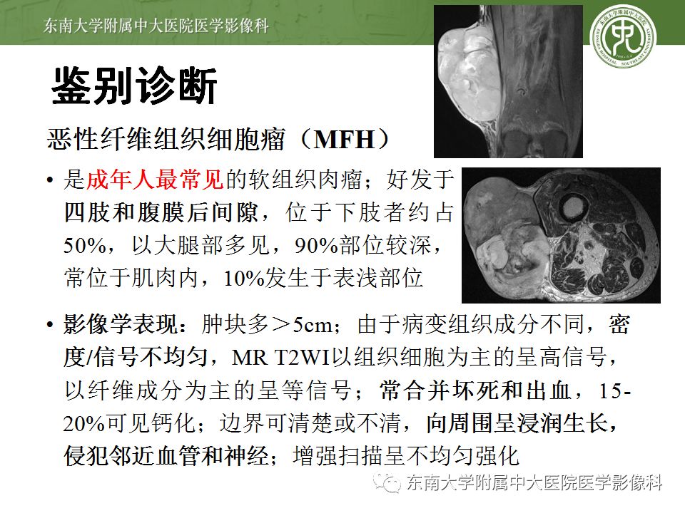 【病例】大腿黏液纤维肉瘤1例MR影像表现
