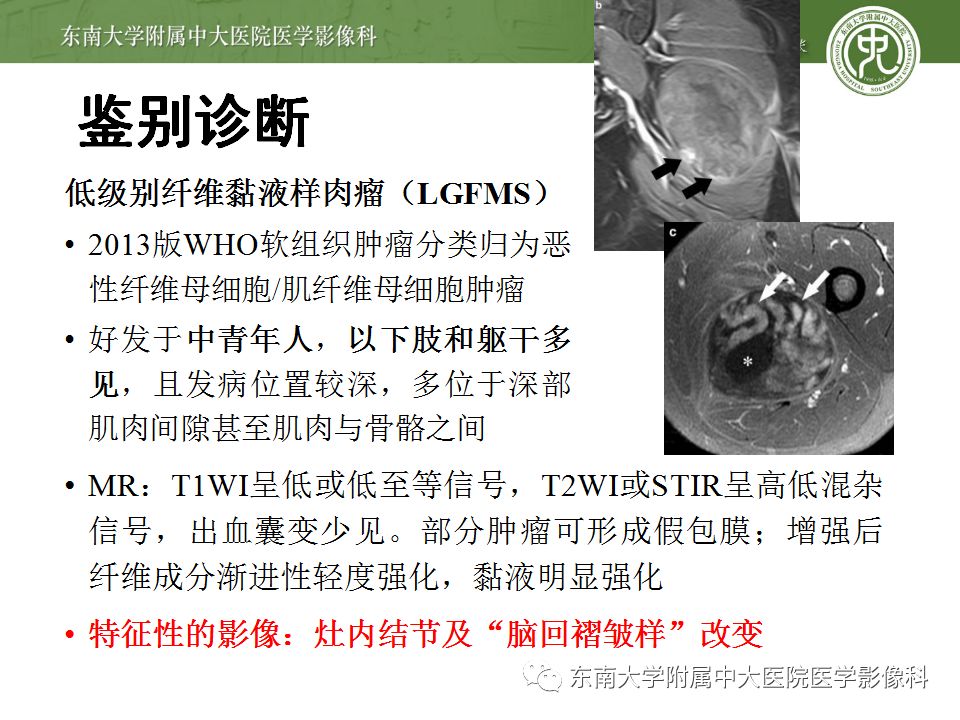 【病例】大腿黏液纤维肉瘤1例MR影像表现