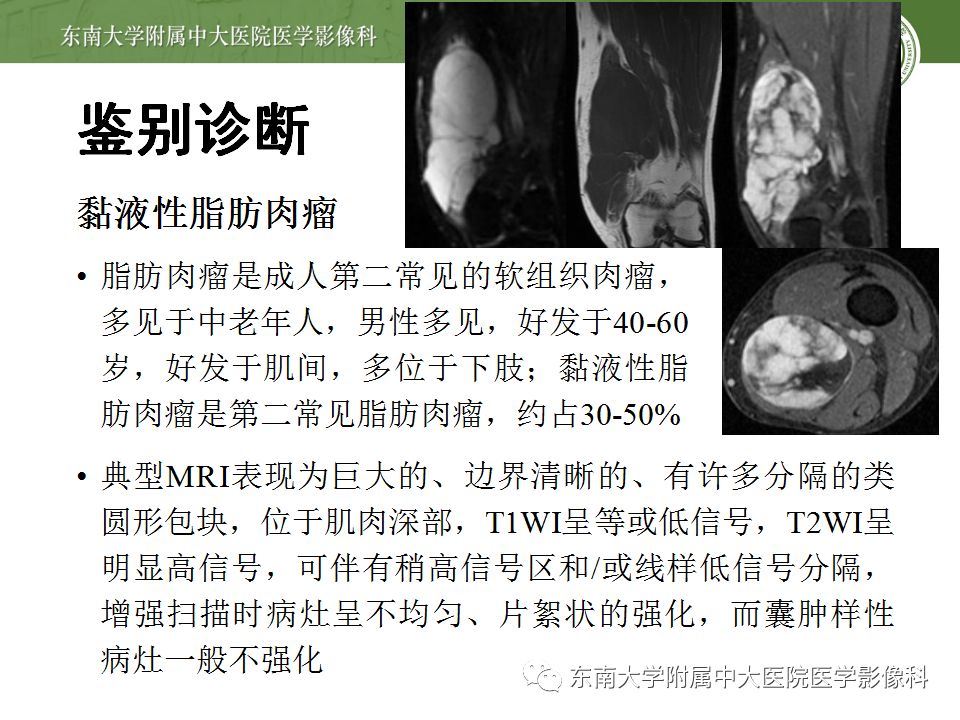 【病例】大腿黏液纤维肉瘤1例MR影像表现