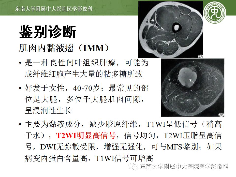 【病例】大腿黏液纤维肉瘤1例MR影像表现