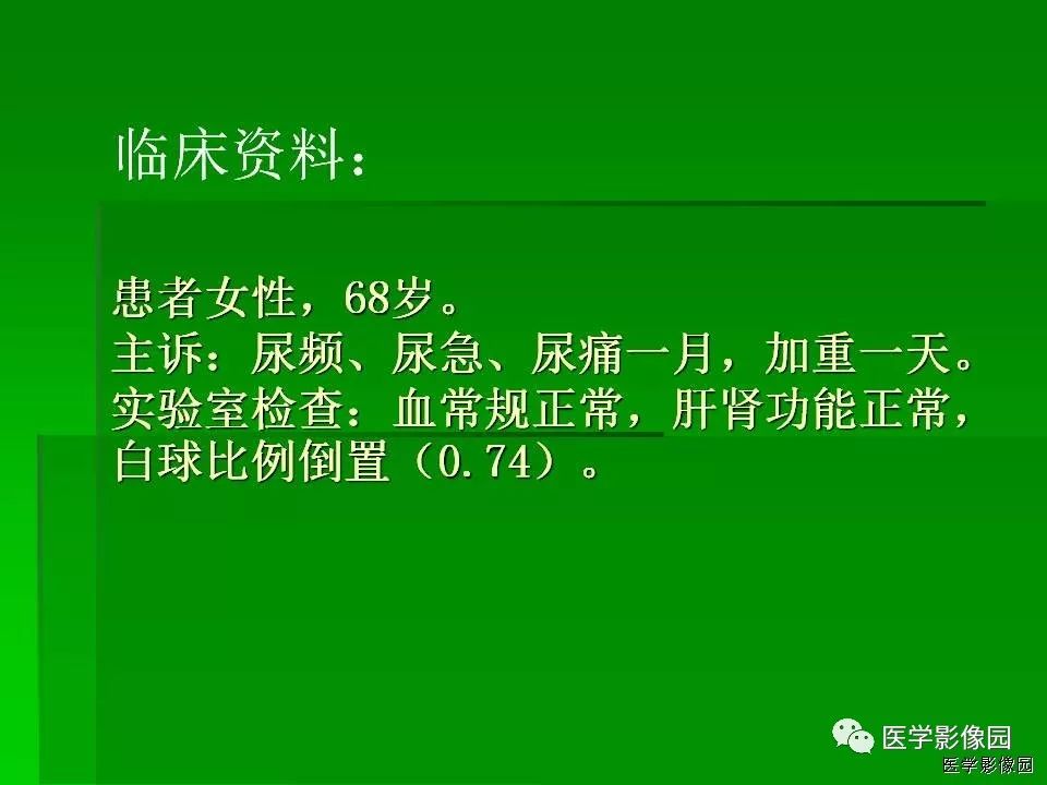 【病例】阑尾黏液腺癌1例CT影像表现