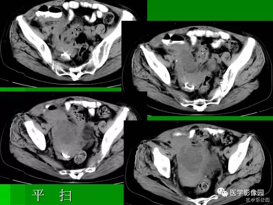 【病例】阑尾黏液腺癌1例CT影像表现 【病例】阑尾黏液腺癌1例CT影像表现
