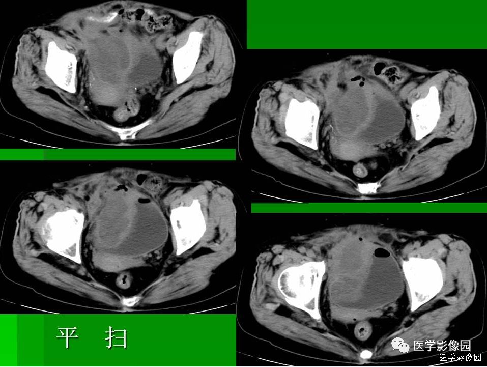 【病例】阑尾黏液腺癌1例CT影像表现 【病例】阑尾黏液腺癌1例CT影像表现