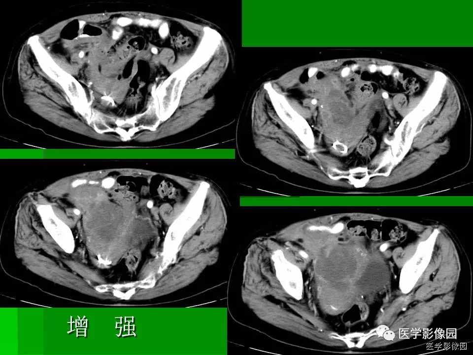 【病例】阑尾黏液腺癌1例CT影像表现 【病例】阑尾黏液腺癌1例CT影像表现