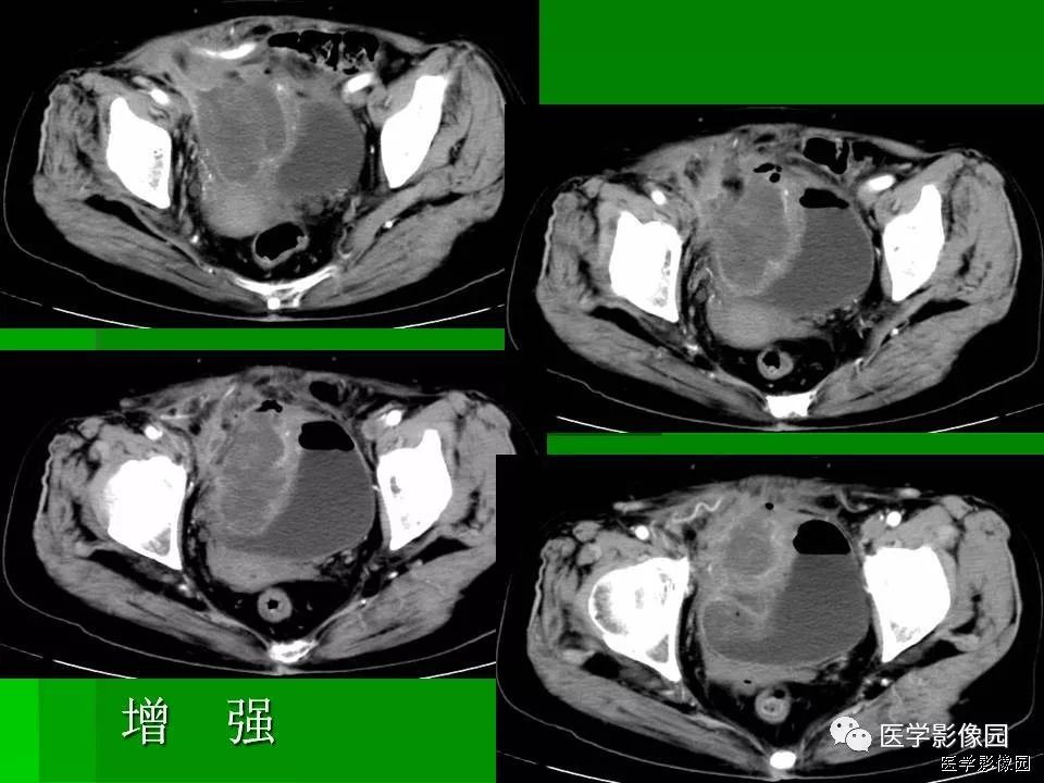 【病例】阑尾黏液腺癌1例CT影像表现 【病例】阑尾黏液腺癌1例CT影像表现