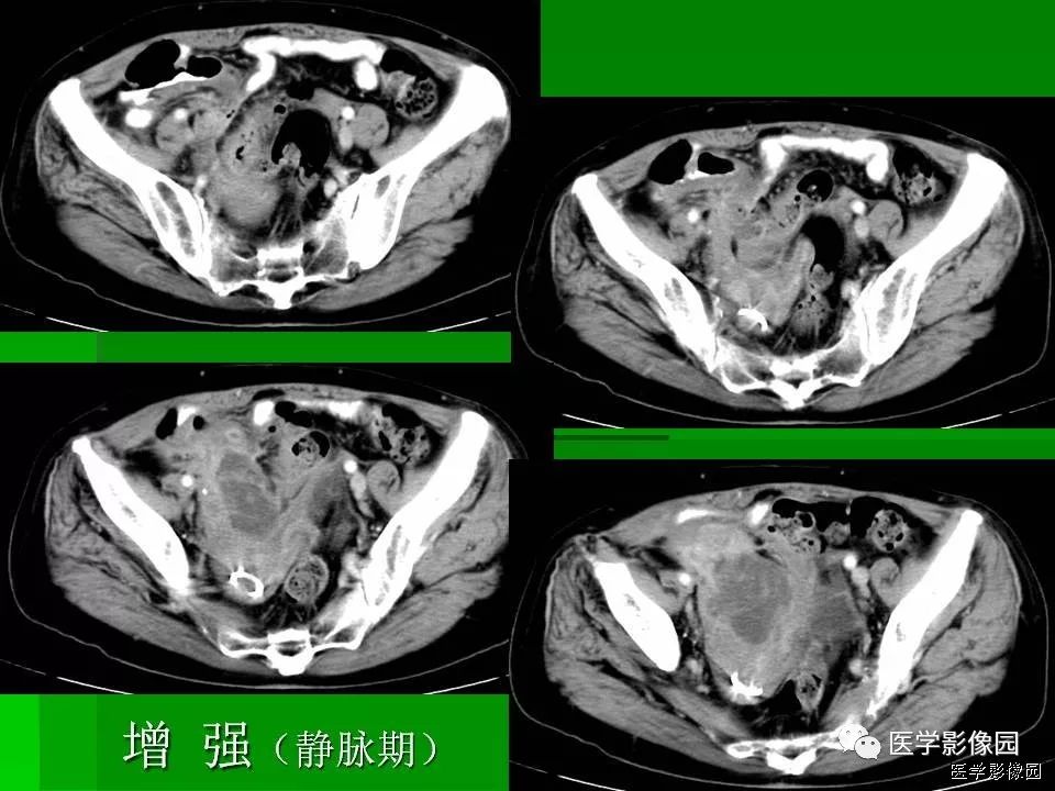 【病例】阑尾黏液腺癌1例CT影像表现 【病例】阑尾黏液腺癌1例CT影像表现