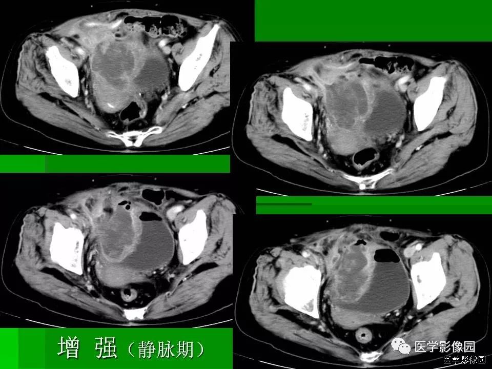 【病例】阑尾黏液腺癌1例CT影像表现 【病例】阑尾黏液腺癌1例CT影像表现