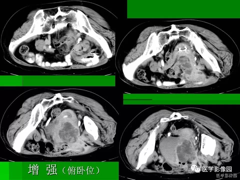 【病例】阑尾黏液腺癌1例CT影像表现 【病例】阑尾黏液腺癌1例CT影像表现