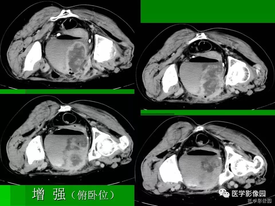 【病例】阑尾黏液腺癌1例CT影像表现 【病例】阑尾黏液腺癌1例CT影像表现