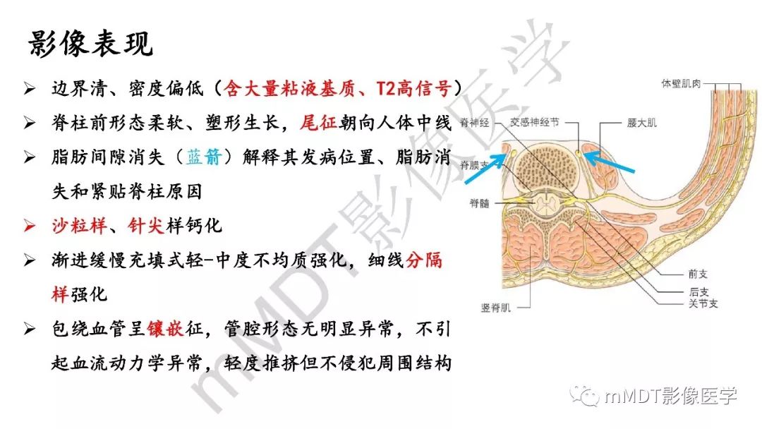 【PPT】节细胞神经瘤影像诊断