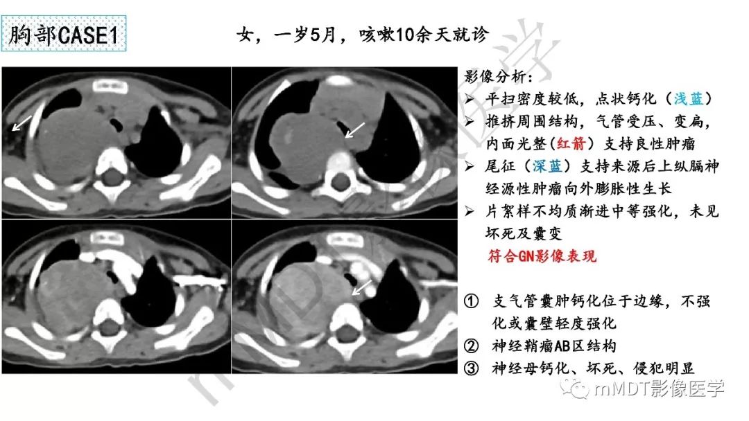 【PPT】节细胞神经瘤影像诊断