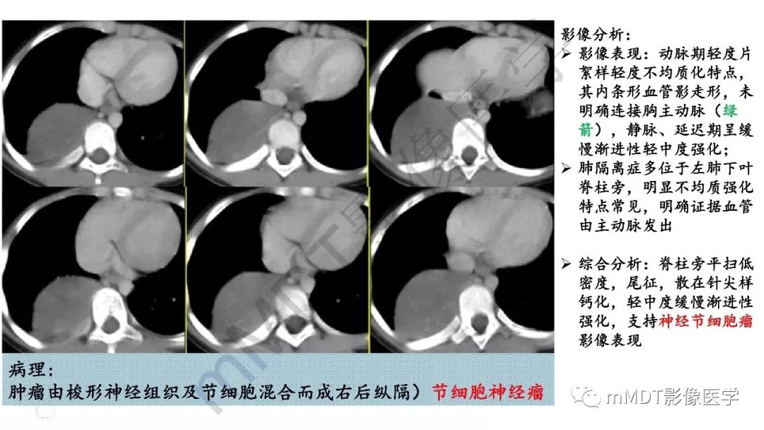 【PPT】节细胞神经瘤影像诊断