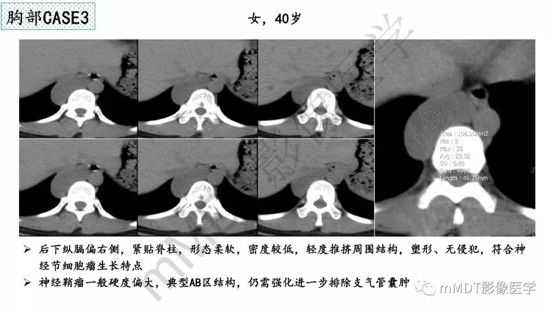 【PPT】节细胞神经瘤影像诊断