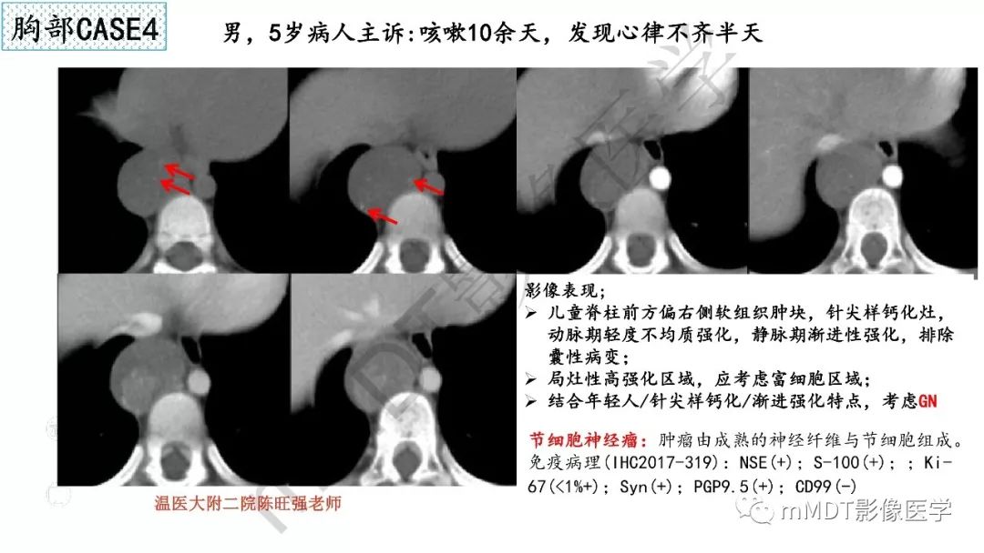 【PPT】节细胞神经瘤影像诊断