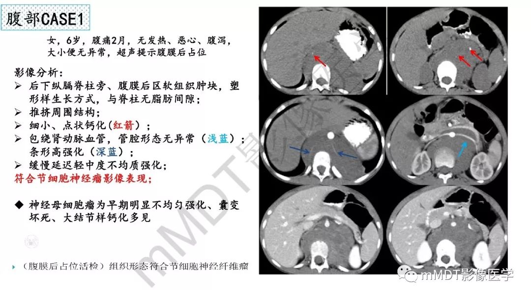 【PPT】节细胞神经瘤影像诊断