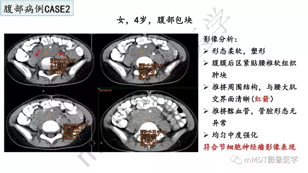 【PPT】节细胞神经瘤影像诊断
