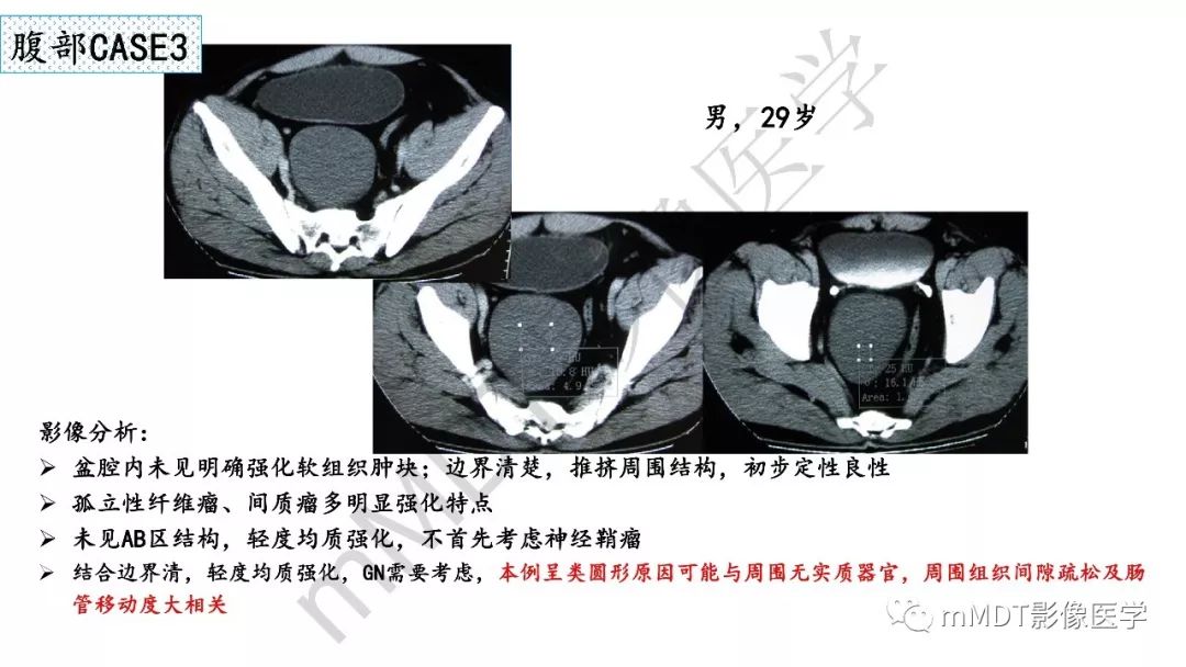 【PPT】节细胞神经瘤影像诊断