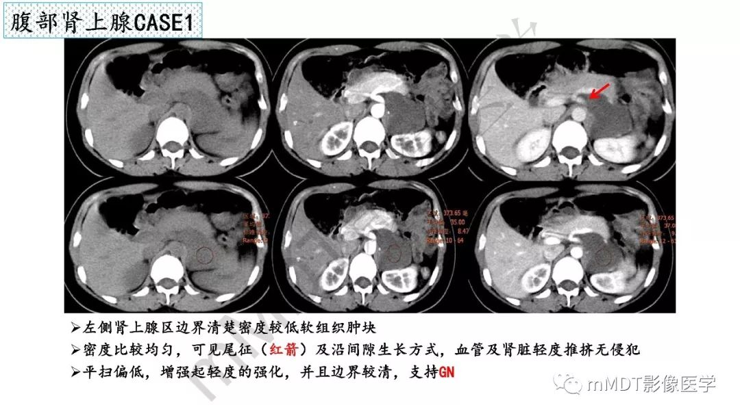 【PPT】节细胞神经瘤影像诊断
