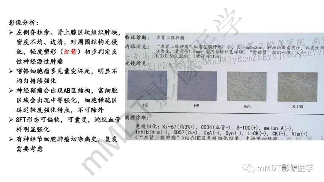 【PPT】节细胞神经瘤影像诊断