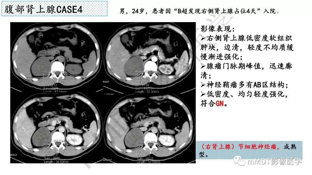 【PPT】节细胞神经瘤影像诊断