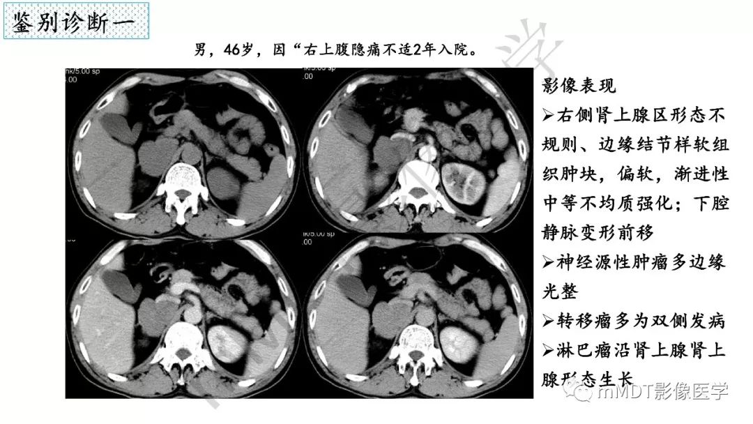 【PPT】节细胞神经瘤影像诊断