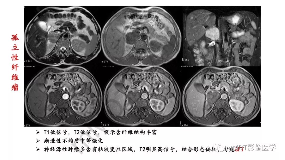 【PPT】节细胞神经瘤影像诊断