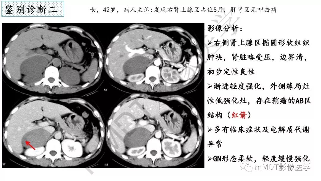 【PPT】节细胞神经瘤影像诊断
