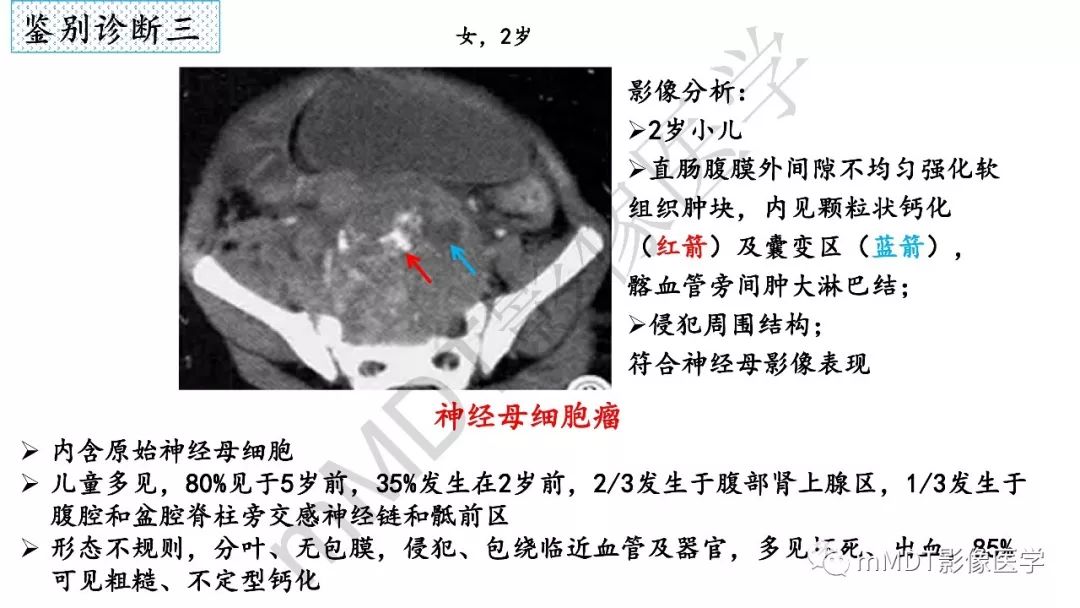 【PPT】节细胞神经瘤影像诊断