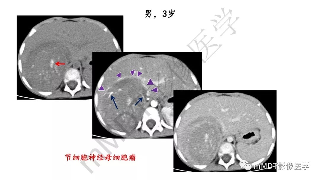 【PPT】节细胞神经瘤影像诊断