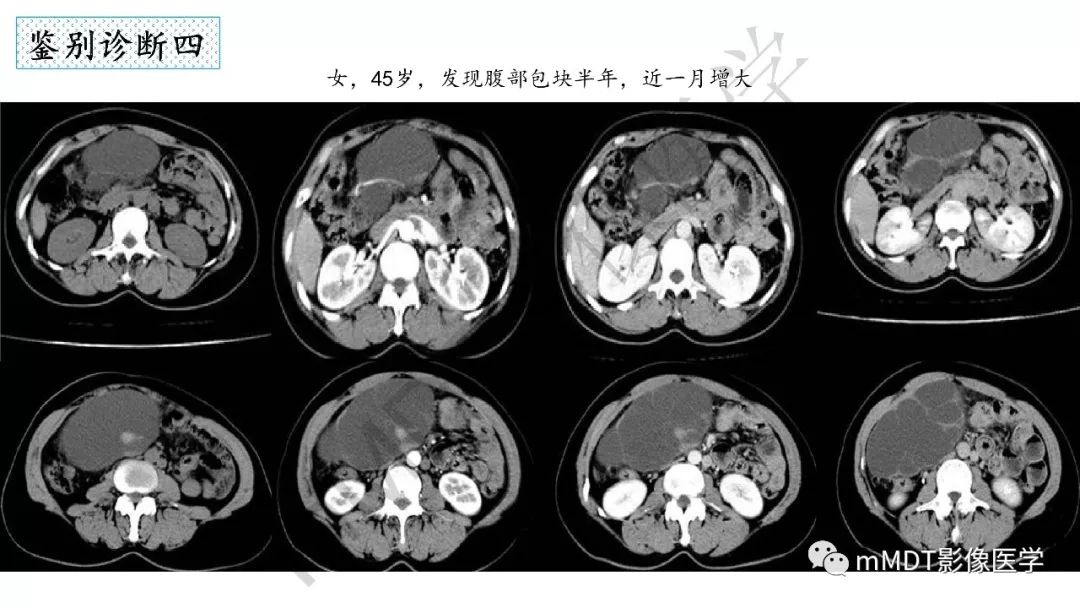 【PPT】节细胞神经瘤影像诊断