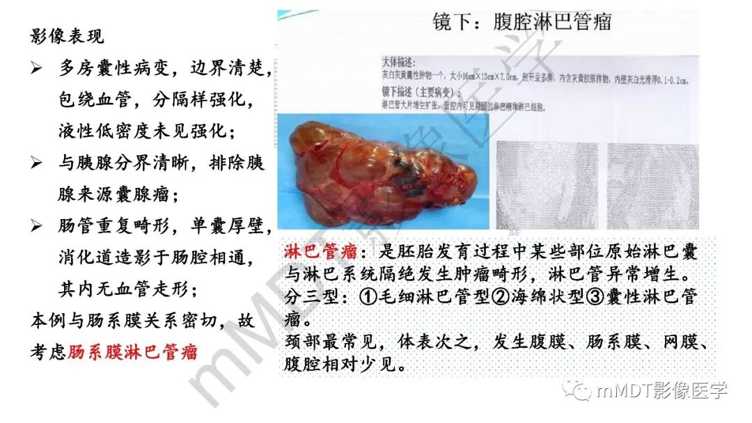 【PPT】节细胞神经瘤影像诊断