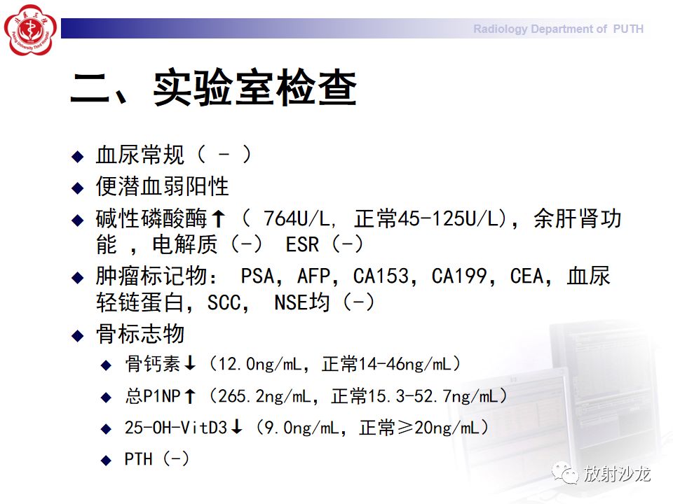 【病例】骶骨转移瘤1例CT及MR影像表现