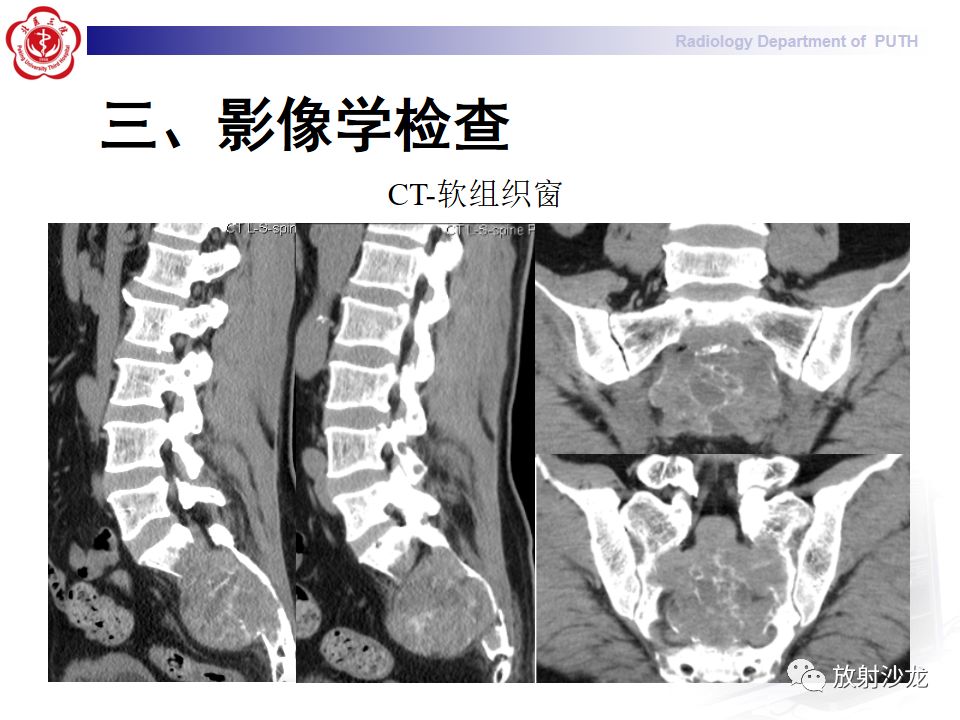【病例】骶骨转移瘤1例CT及MR影像表现