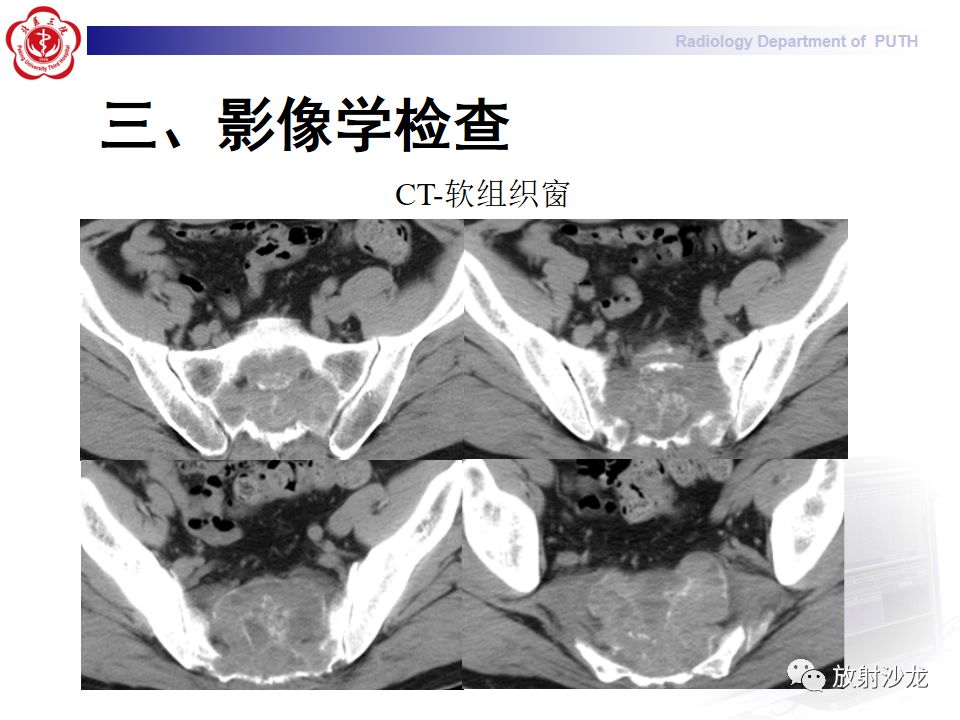 【病例】骶骨转移瘤1例CT及MR影像表现