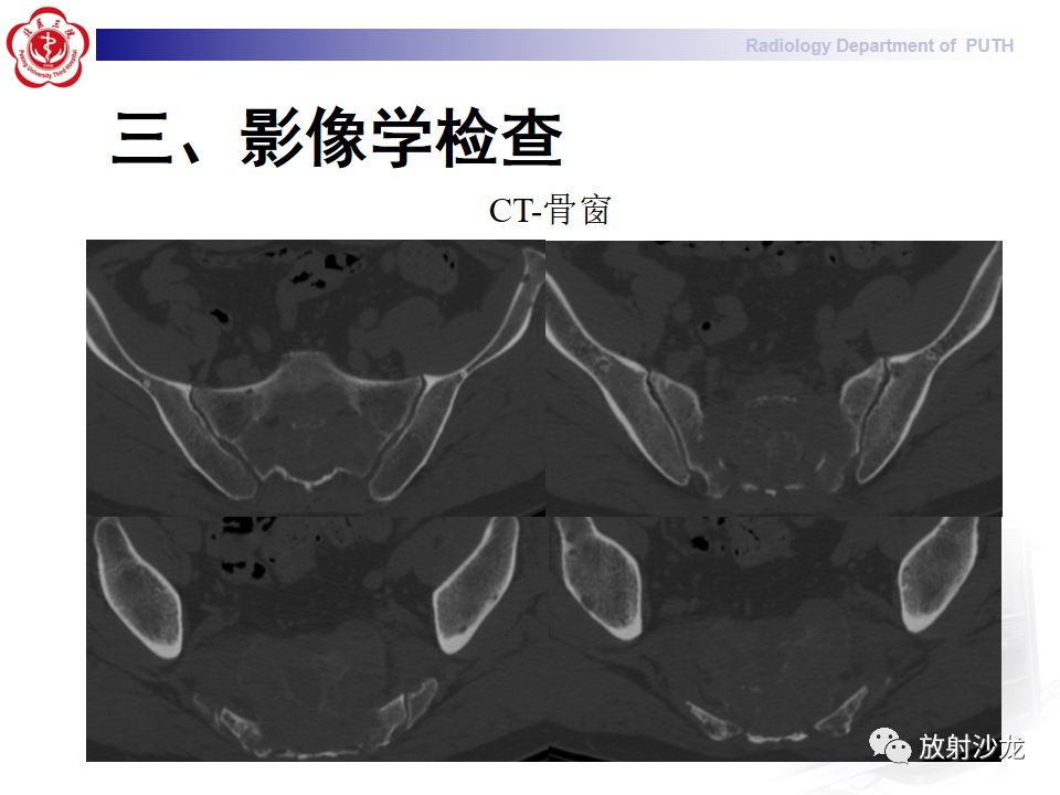 【病例】骶骨转移瘤1例CT及MR影像表现