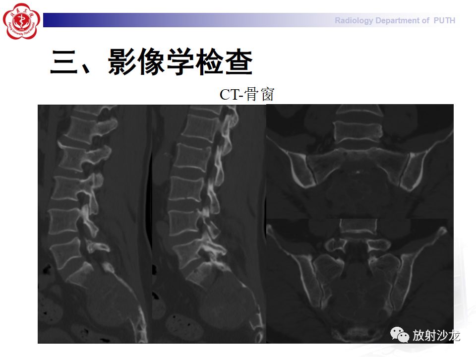【病例】骶骨转移瘤1例CT及MR影像表现