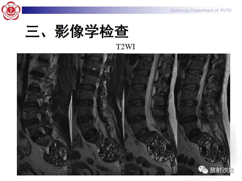 【病例】骶骨转移瘤1例CT及MR影像表现